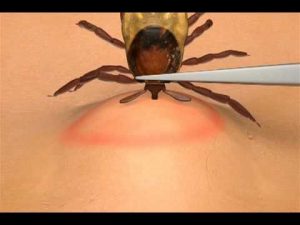 How to remove a tick- as advised by national support group Tick Talk Ireland