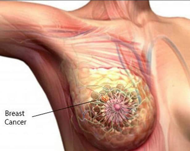 Breast cancer 