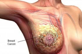 Breast cancer 