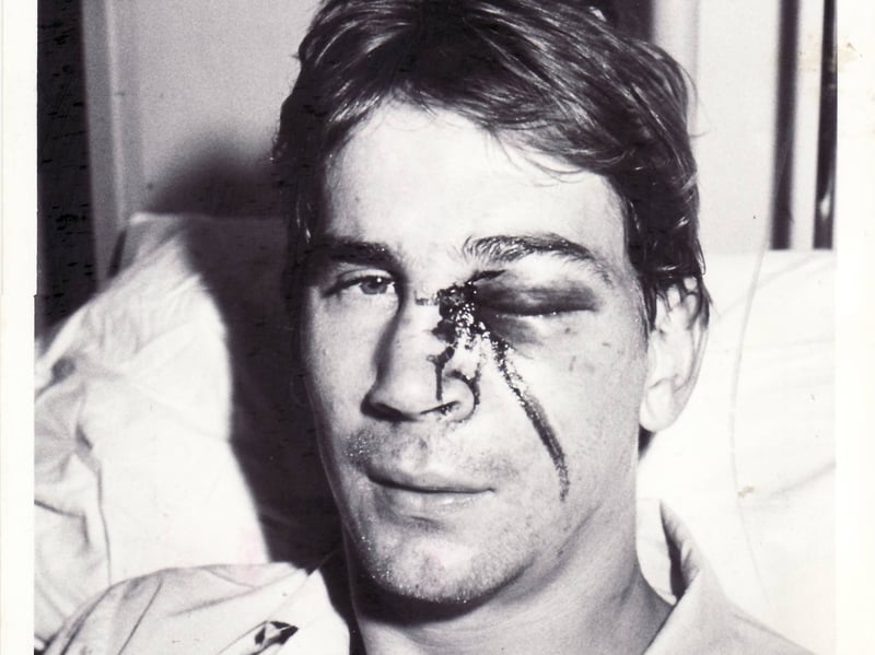 Alan Knight with a nasty injury
