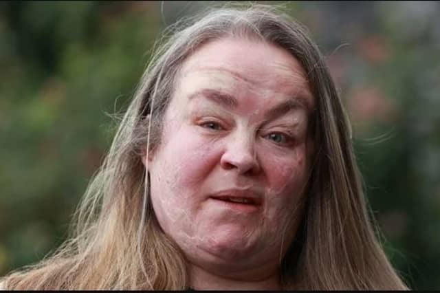 Omagh bomb survivor Donna Marie McGullion has condemned the conditions she witnessed at Altnagelvin Hospital saying she saw healthcare staff struggling to cope with the demands placed upon them. SU6844CD26